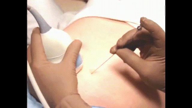 唐筛低风险还有必要羊水穿刺吗,唐筛查出胎儿染色体异常