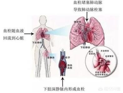 骨折术后下肢血栓好治吗,骨折术后怎样预防下肢静脉血栓