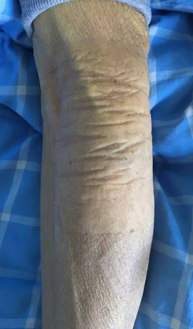 造影剂外渗用什么敷料,造影剂外渗后怎么处理