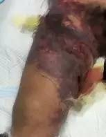 感冒脓毒血症,小孩感冒引起的脓毒血症