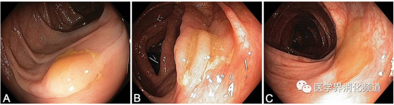 无蒂锯齿状腺瘤是什么,锯齿状腺瘤切除后还会恶变吗