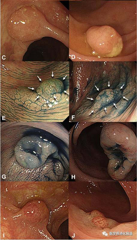 无蒂锯齿状腺瘤是什么,锯齿状腺瘤切除后还会恶变吗