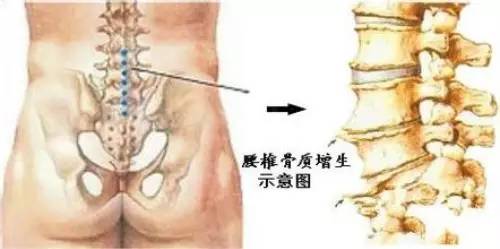 45岁腰酸背痛是什么原因引起的,腰酸背痛是什么原因引起的男人