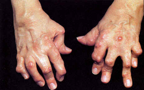 风湿全解｜夏季风湿关节炎危害大，如何有效治疗和预防？