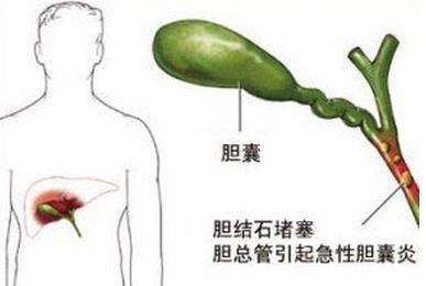 无症状的胆结石会消失吗,胆结石15mmx12mm无症状有危害吗