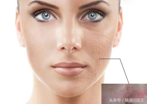 痘坑怎么修复点阵激光操作过程,激光痘疤修复凹洞痘坑要多久