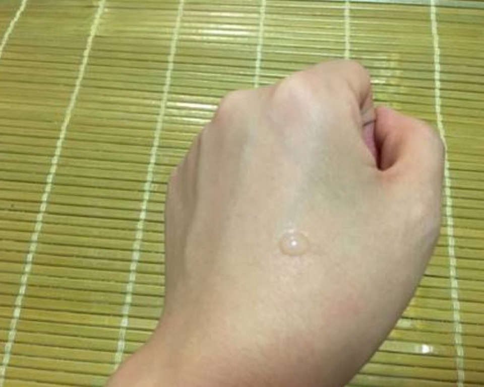 为什么来姨妈会长痘痘,为什么额头会长痘痘