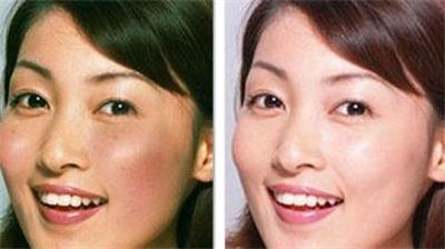 激光治疗祛雀斑,激光祛雀斑的最佳方法