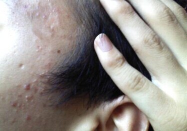 消了又长的疮是什么疮,脸部长疮的症状和治疗方法