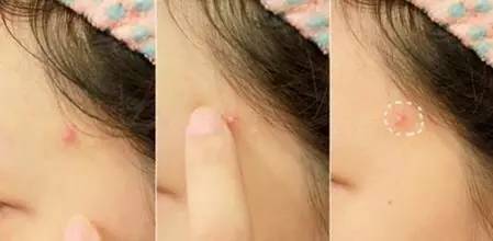 额头和鼻子反复长痘痘怎么回事,右额头长痘痘是什么原因引起的