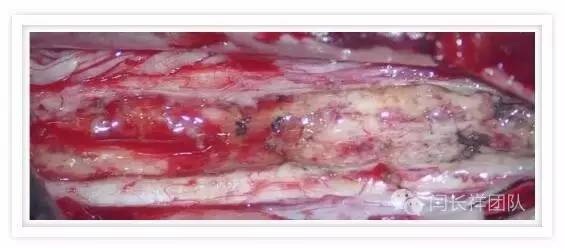 闫长祥脑膜瘤,闫长祥能治愈弥漫中线胶质瘤吗