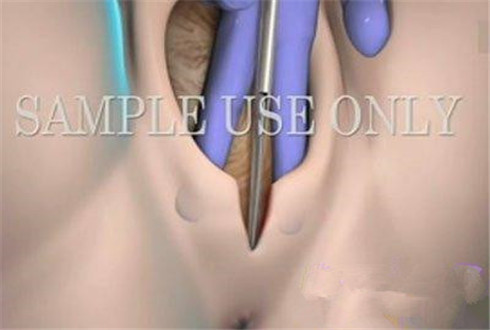 动画演示宝宝分娩侧切过程,产妇分娩侧切