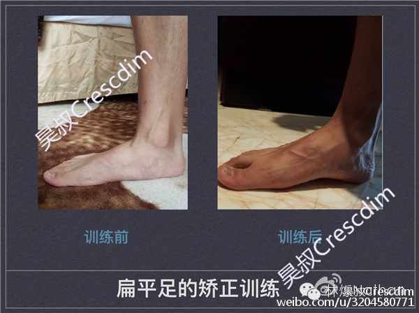 扁平足的矫正方法,2岁扁平足需要矫正么