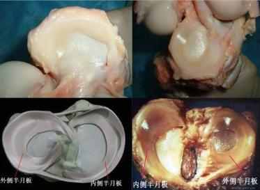 膝关节疼痛伸缩有响声怎样治疗,膝关节活动有轻微弹响