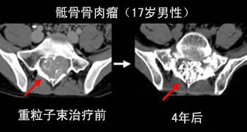 骨肉瘤国外有特效药吗,国外骨肉瘤治疗方法