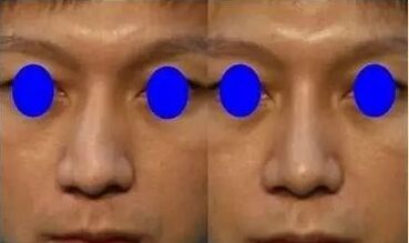 歪鼻子怎么办,歪鼻子有什么办法呢