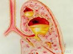 胸腔积液怎么治才能除根,胸腔积液怎么治才能彻底除根