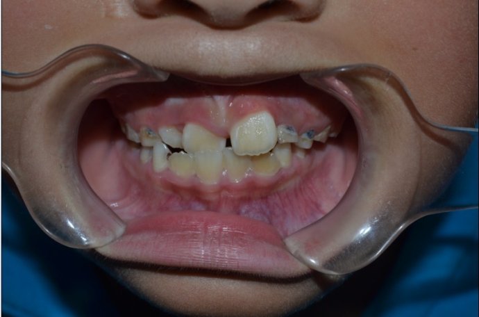 小孩乳牙蛀牙做根管治疗还是拔牙,小孩乳牙有蛀牙洞要治疗吗