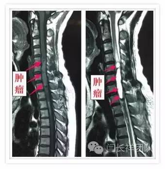 闫长祥脑膜瘤,闫长祥能治愈弥漫中线胶质瘤吗