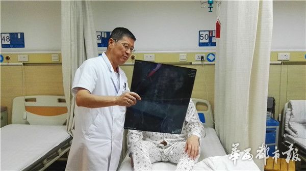 男子结石取出1200颗石头,有结石经常做体外碎石