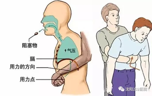 成功抢救一名卡喉患儿,女孩被卡喉医生合力救回