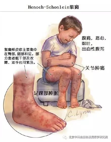 过敏性紫癜案例分享,过敏性紫癜的基本常识