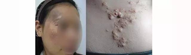 初生婴儿痣和胎记怎么区别,孩子长痣和胎记区别