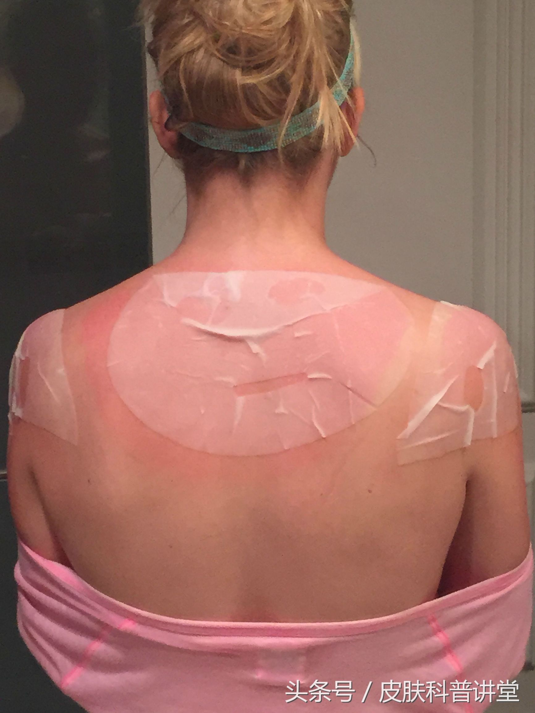 海滩玩的时间长把皮肤晒伤怎么办,皮肤晒伤但是要出门怎么保护