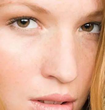 祛痘痘闭口粉刺的方法,怎么正确挤闭口粉刺