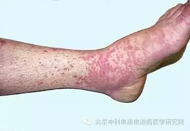中国最出名的治疗过敏性紫癜专家,儿童过敏性紫癜怎么治疗的短视频