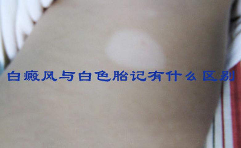 婴儿身上有痣和胎记,婴儿胎记和痣怎么区分