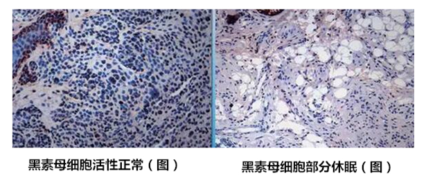 治疗白癜风时务必重视这几大事项,治疗白癜风一定要调整心态