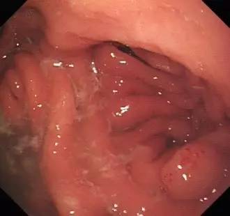 胃镜预处理流程,胃镜内镜手术全流程