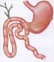 胃镜预处理流程,胃镜内镜手术全流程