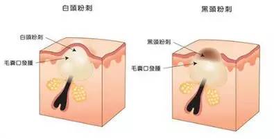 有效去黑头的方法让你摆脱草莓鼻,去黑头小妙招种草