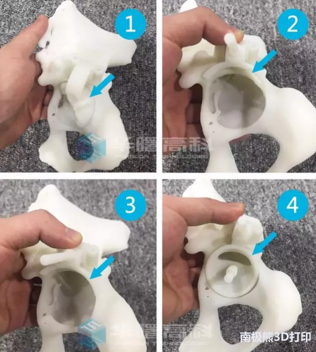 华曙高科3D打印辅助全髋关节置换术成功率达100%