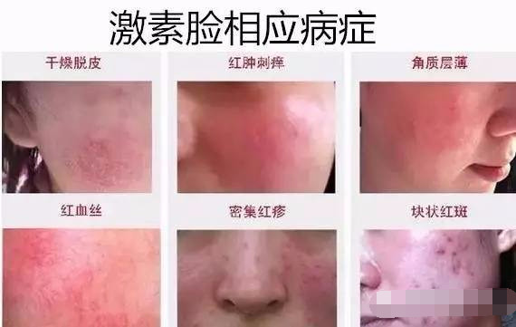 真实的激素脸有多可怕,激素脸凉可怕吗