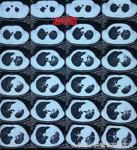 72岁老爷子，肺癌晚期，喘不上气，经这么一治疗竟然好多了