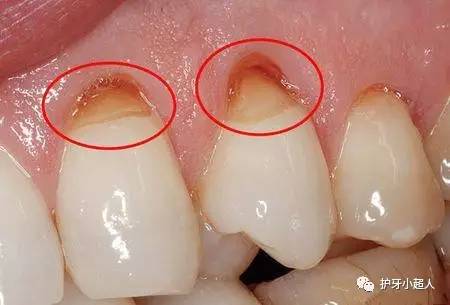 牙齿有洞但没有黑是虫牙吗,牙齿有洞不黑要补牙吗