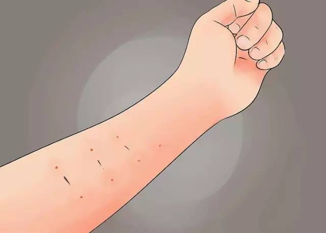 纹身过敏症状怎么处理,纹身细菌感染怎么治疗