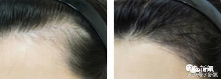 杨幂发际线还会回归吗,杨幂发际线秃到后脑勺