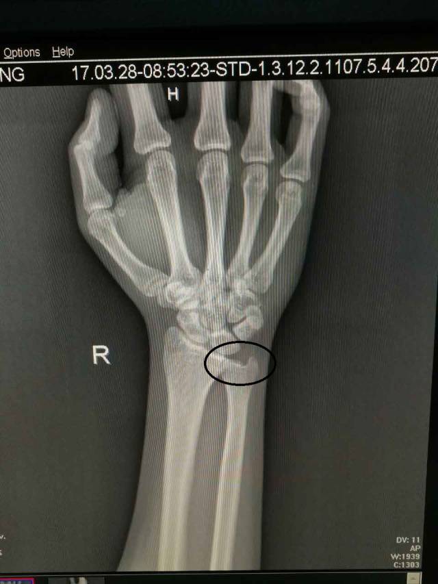 腕部损伤恢复方法,腕部受伤一般多久恢复