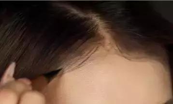 年轻人如何改善发量稀疏,发量稀少怎么补救最快最有效