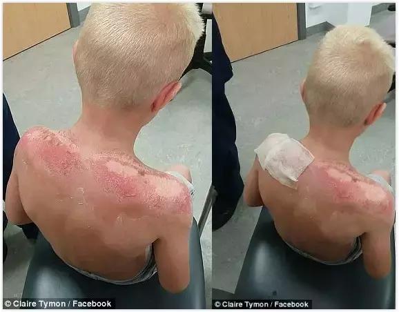 儿童涂防晒霜之前需要涂防晒霜吗,香蕉船防晒霜晒伤事件