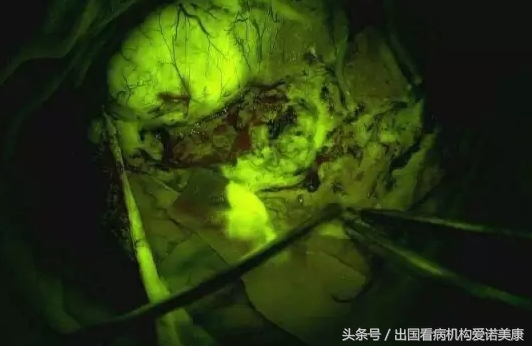 回国教授开发癌症药,引进新药治疗癌症