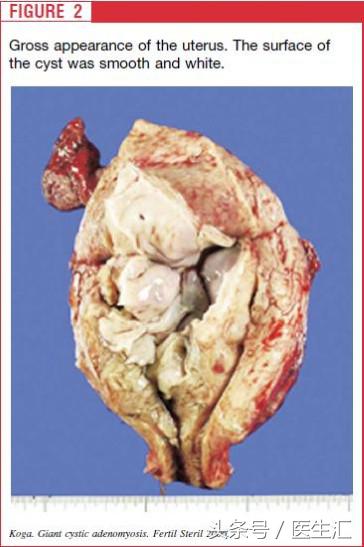 年轻子宫腺肌症患者综合治疗的病例分析