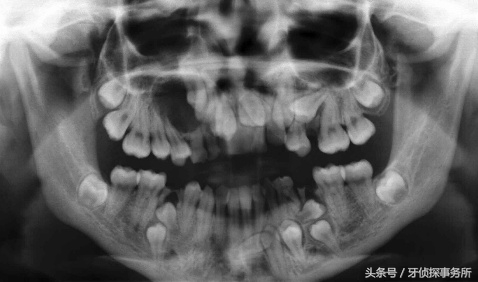 牙齿不整齐跟饮食有关吗,牙齿长乱了说话清楚吗