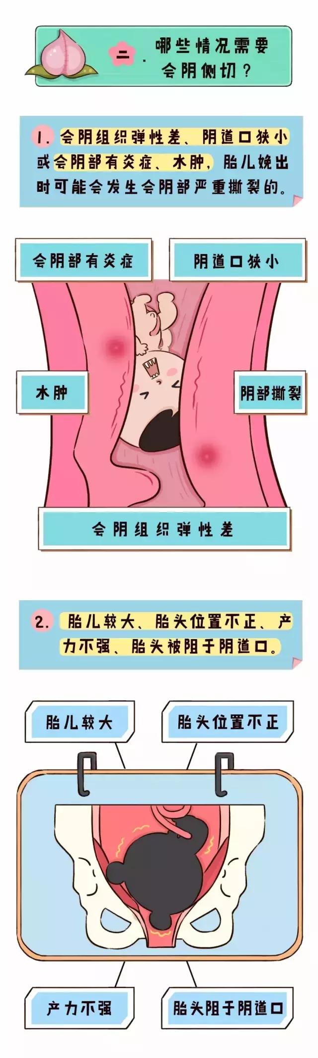 顺产可不可以不侧切,顺产会被缝针么