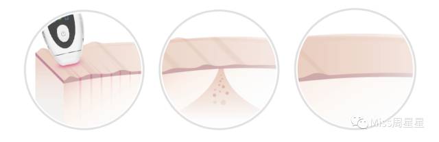 iluminage激光美容仪有哪些功效,紧致去皱美白美容仪