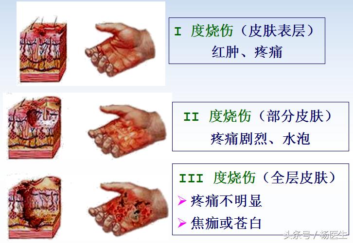 烫伤家庭急救五字诀,烧烫伤急救五部曲图片